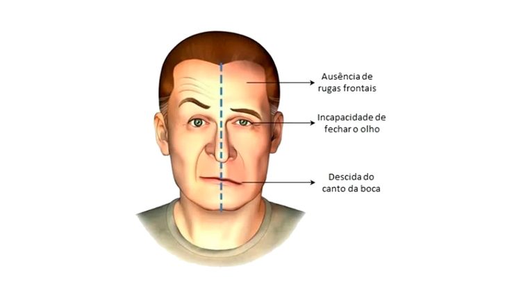 Paralisia facial: por que (e quando) acontece?