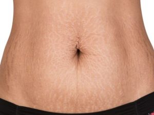 54% das mulheres brasileiras se queixam de estrias e dizem afetar a autoestima, segundo pesquisa