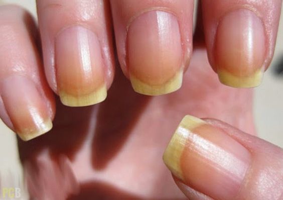 Se a sua unha falasse: entenda o que suas unhas querem dizer sobre sua saúde